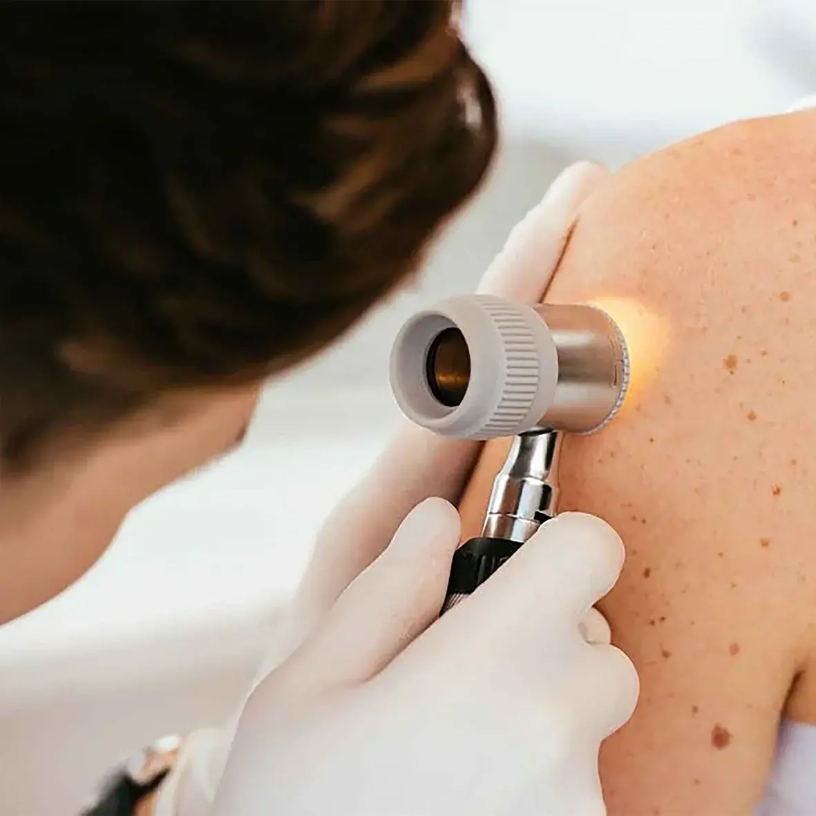 Examen dermoscopique des lésions cutanées